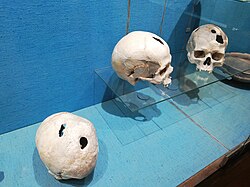 Skulls from the Bronze Age exhibited at the Musée archéologique de Saint-Raphaël (Archeological Museum of Saint-Raphaël), found in Comps-sur-Artuby (France). The subjects survived operations.