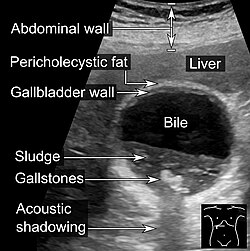 Abdominal ultrasonography showing biliary sludge and gallstones