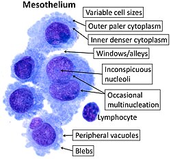 Cytology of normal mesothelium, with typical features. Wright's stain.