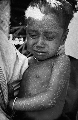 Three-year-old Rahima Banu of Bangladesh (pictured) was the last person infected with naturally occurring variola major, in 1975.