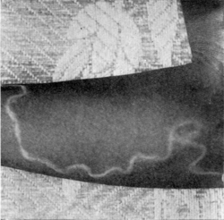 Carl Linnaeus described nematodes including the parasitic Dracunculus medinensis, seen here under a person's skin.[21]
