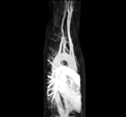 Magnetic resonance angiography of aberrant subclavian artery