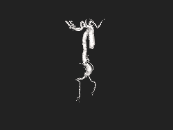 3D file showing an aortic aneurysm