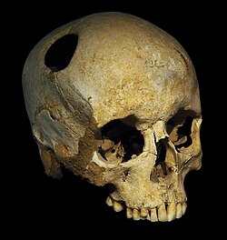 The perimeter of the hole in this trepanated Neolithic skull is rounded off by ingrowth of new bony tissue, indicating that the patient survived the operation.