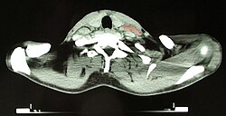 CT image of a 46-year-old person with Hodgkin lymphoma, image at neck height. On the left side of the person's neck enlarged lymph nodes are visible (marked in red).
