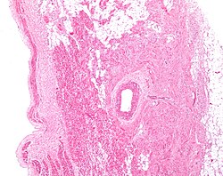 Figure 2: Low magnification stained image of the SA node (center-right on image) and its surrounding tissue. The SA node surrounds the sinoatrial nodal artery, seen as the open lumen. Cardiac muscle cells of the right atrium can be seen to the left of the node, and fat tissue to the right.