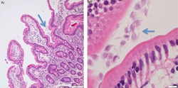 A duodenal biopsy may incidentally detect Giardia organisms, as in this H&E stained sample.[41]