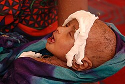 A Somali boy receiving treatment for malnourishment at a health facility