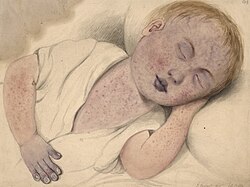 Child with congenital heart disease with central cyanosis that is worsened by measles. Note the bluish-purple discoloration of the fingernails, lips, eyelids, and nose, along with prominent nail clubbing.