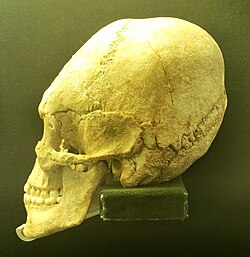Skull of a Hun-period person found in Hungary showing artificial cranial deformation. Over 200 artificially deformed skulls have been found in the Carpathian Basin from the Hun and Avar periods.[173]