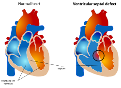 A diagram of a healthy heart and one suffering from ventricular septal defect