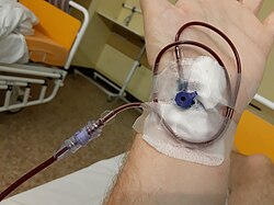 A patient receiving blood transfusion through a cannula