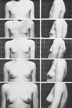 Tanner scale of female breast development