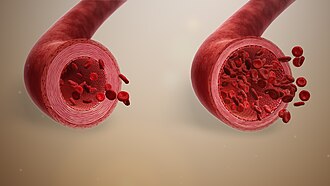 Normal blood vessel (left) vs. vasodilation (right)