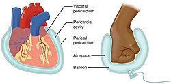 Serous membrane lines the pericardial cavity and reflects back to cover the heart—much the same way that an underinflated balloon would form two layers surrounding a fist.[1]