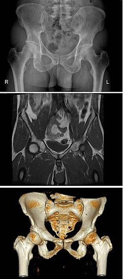 The same human pelvis, front imaged by X-ray (top), magnetic resonance imaging (middle), and three-dimensional computed tomography (bottom)