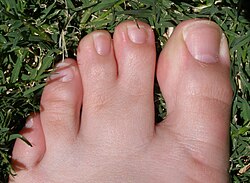Human foot with partial simple syndactyly.