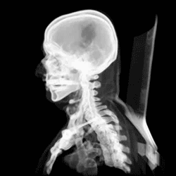 CT scan of a human skull in 3D
