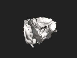 3D model of orbit with surrounding bones